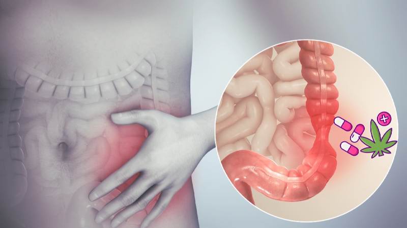 Medicinal Marijuana For IBS