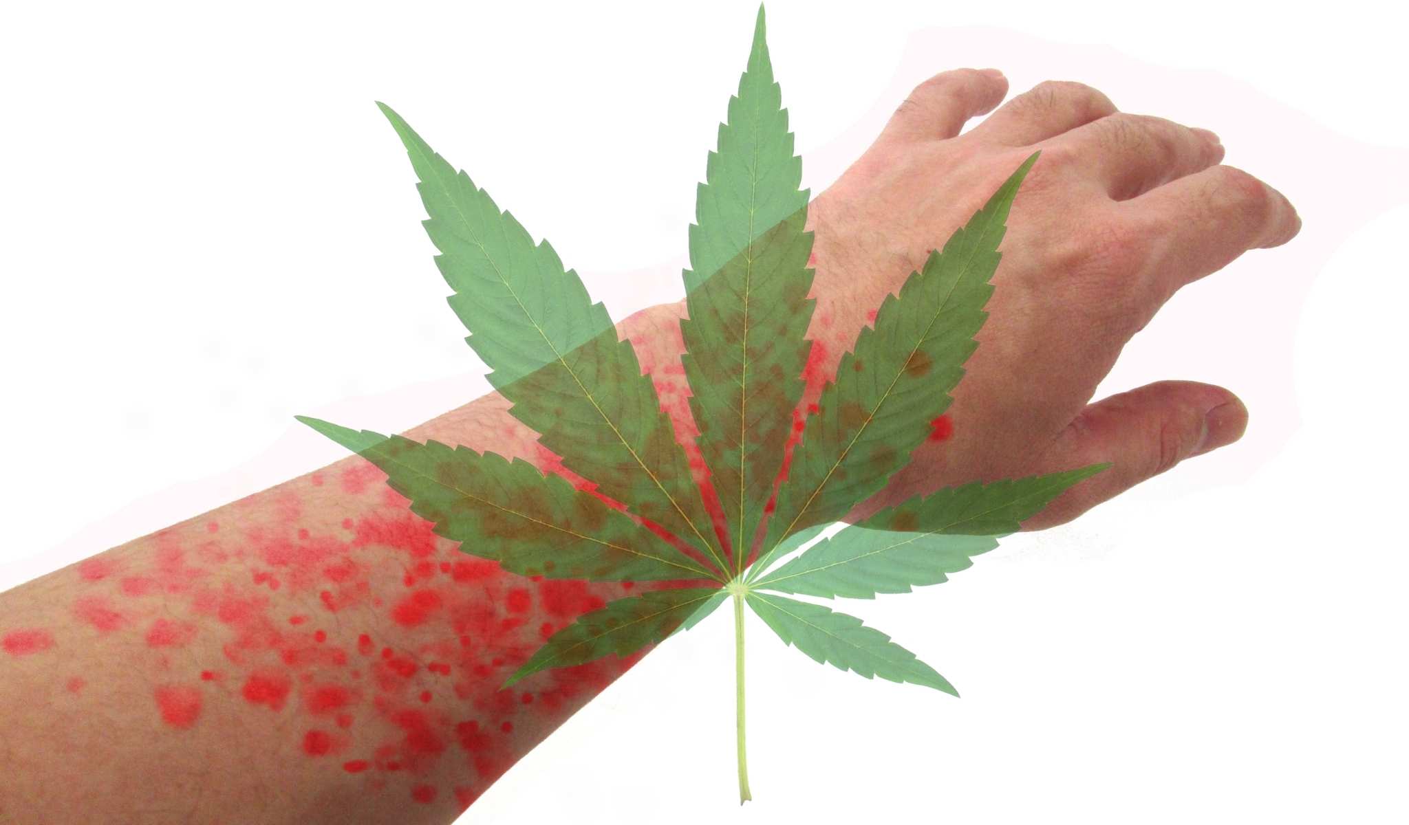 Will CBD Oil Help With Hives? The Role of Cannabidiol in Reducing Inflammation