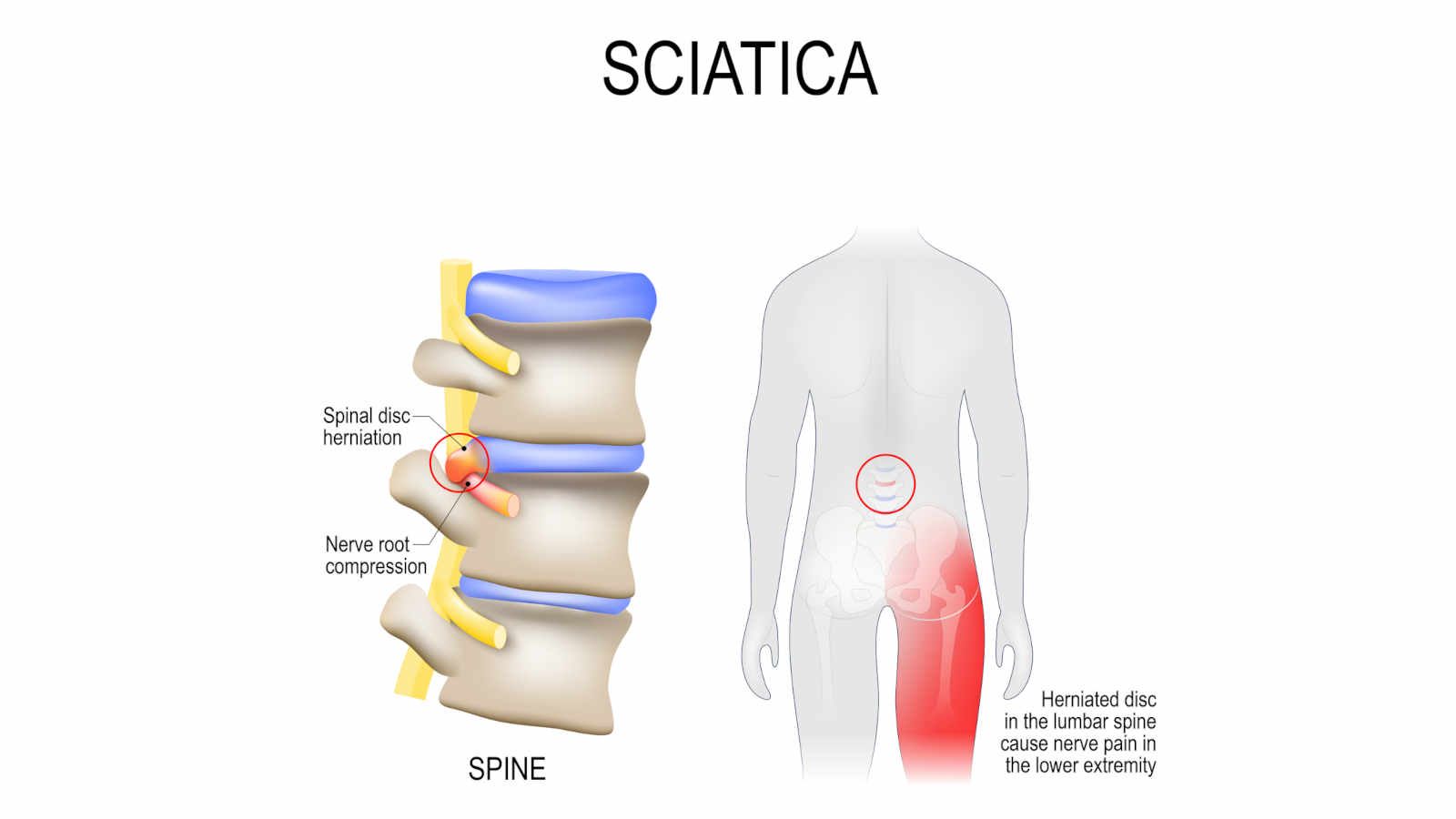 Does CBD Oil Help Sciatica?